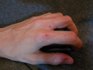 plier-wounds